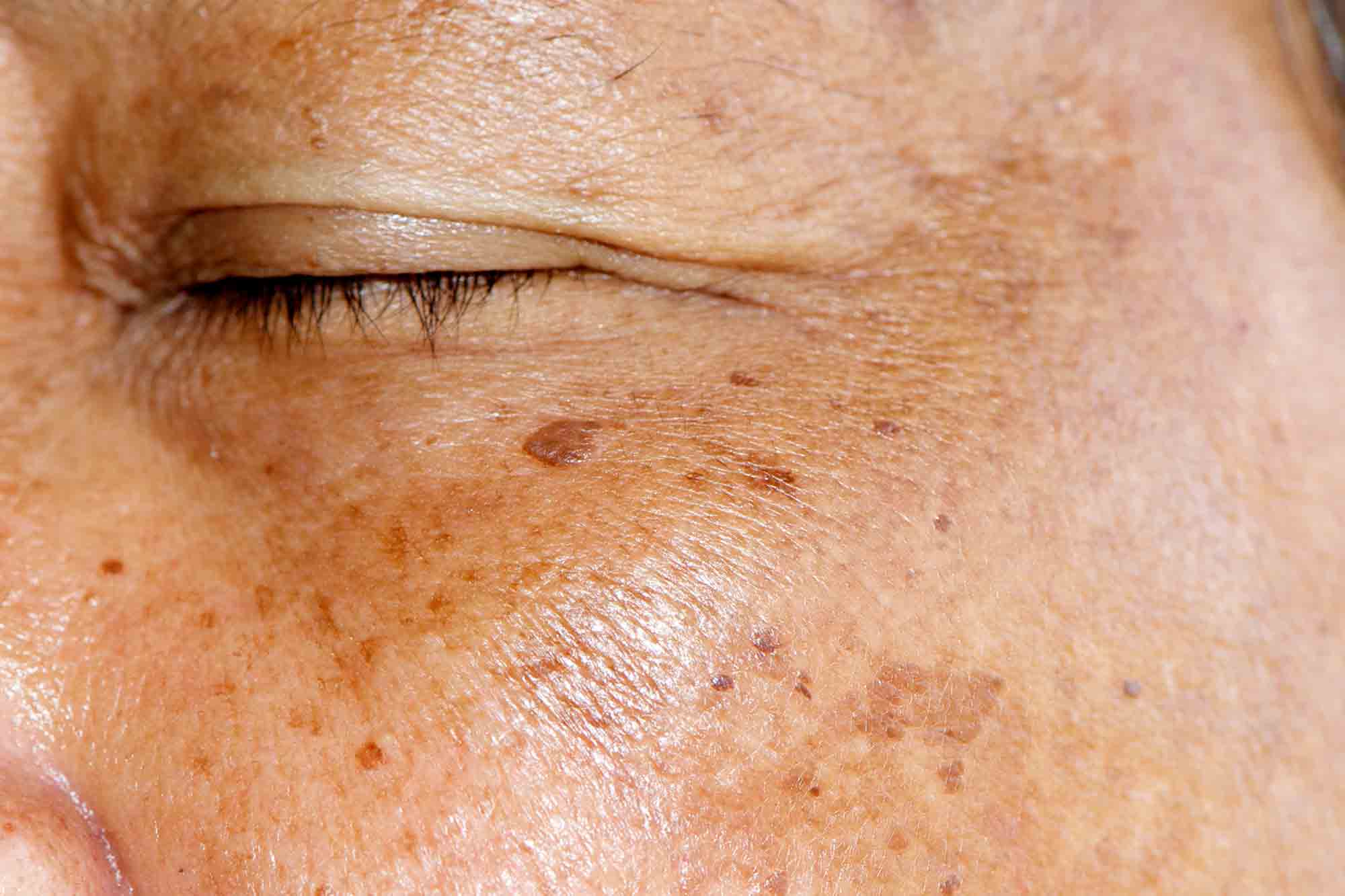 beauty_docs_pigmentflecken_altersflecken_86849754