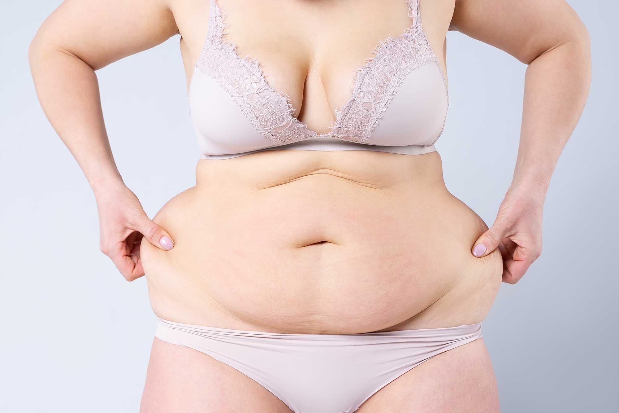 Tummy tuck, flabby skin on a fat belly, plastic surgery concept