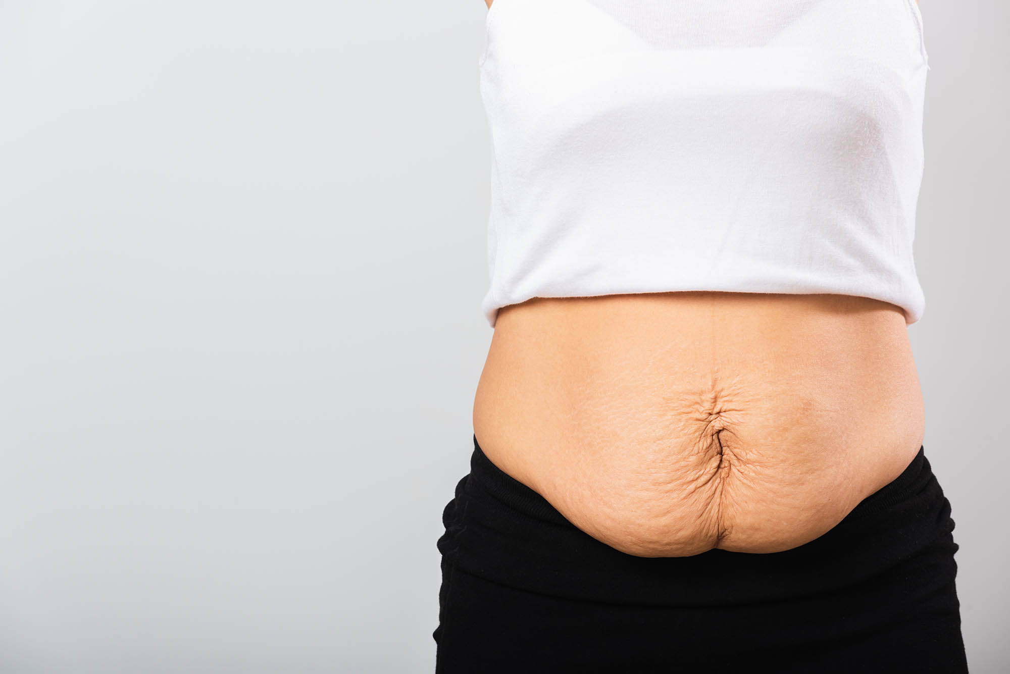 woman showing stretch mark loose lower abdomen skin she fat afte
