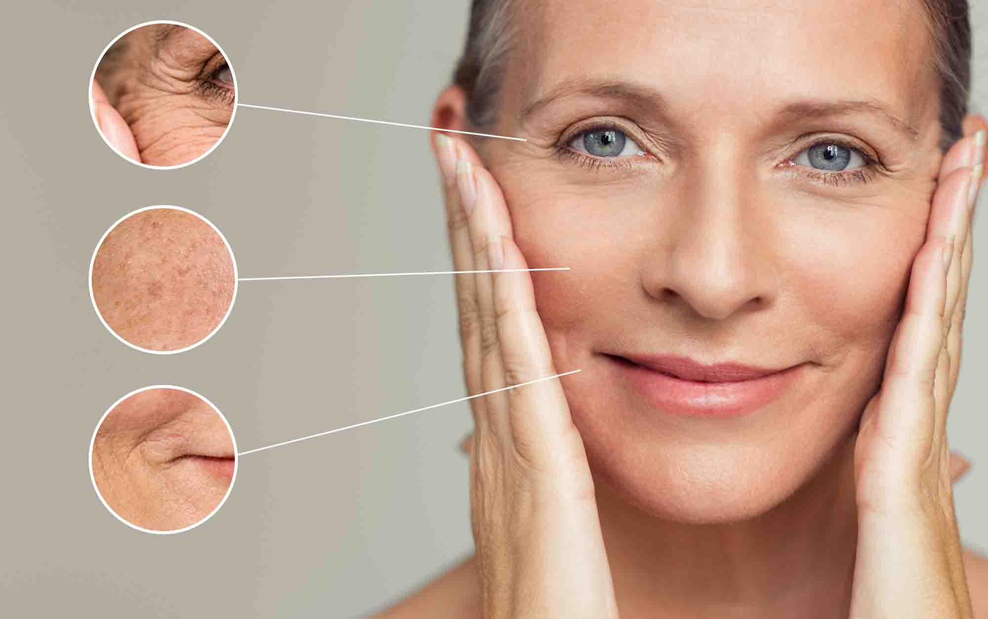 Wrinkles and skin imperfection